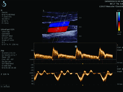 ULTRAFAST DOPPLER