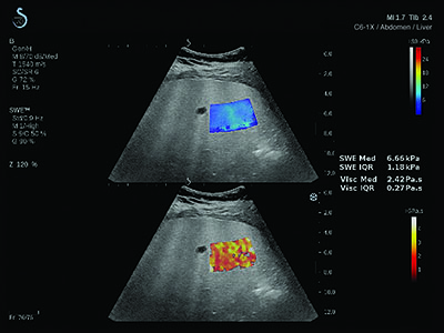 FIBROSIS ASSESSEMENT